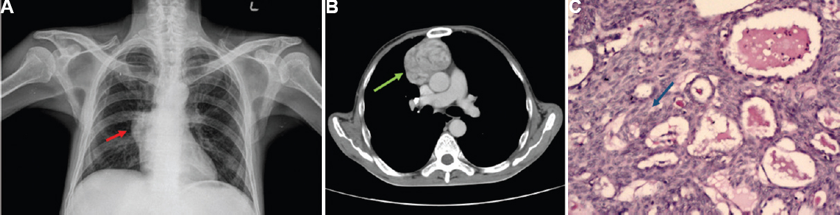 (A) Chest X-ray PA view showing mediastinal widening (red arrow). (B) Axial section of computed tomographic scan showing anterior mediastinal mass (green arrow). (C) H and E section (×100) of the mass showing parenchyma comprising sheets of spindle cells with minimal lymphoid cells (arrow), arranged in short, storiform fascicles, vague whorls and interrupted by cystic spaces with focal microcystic pattern. Vascularity is increased with prominent perivascular spaces. Consistent with WHO-Type A thymoma.